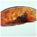 Case reported by Karim Ibnmajdoub Hassani, Julie Rode, Jane Poincenot, Jean-Manuel Gruss