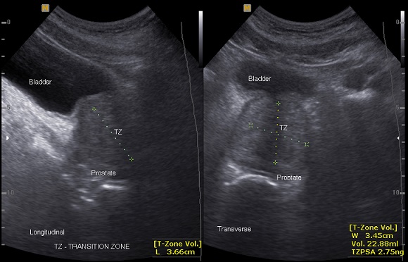 Measuring Shape Prostate Benign Prostatic Hypertrophy Ultrasound
