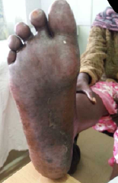 Figure 2: Palmar-plantar erythrodysesthesia associated with capecitabine  chemotherapy: a case report