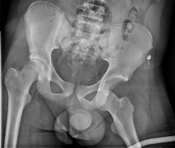 Figure Figure 1 Luxation Obturatrice De La Hanche Un Traumatisme Rare En Pratique Sportive B