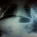 Perforation Gastrique N onatale Spontan e Propos D un Cas perforation-gastrique-n-onatale-spontan-e-propos-d-un-cas