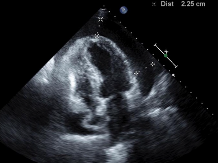 Figure Figure 2-La tamponnade cardiaque: une manifestation rare de ...