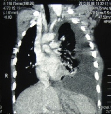 Figure Figure 2-La fistule pancréatico-pleurale chez l'enfant ...