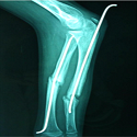 fractures diaphysaires des os de l'avant bras