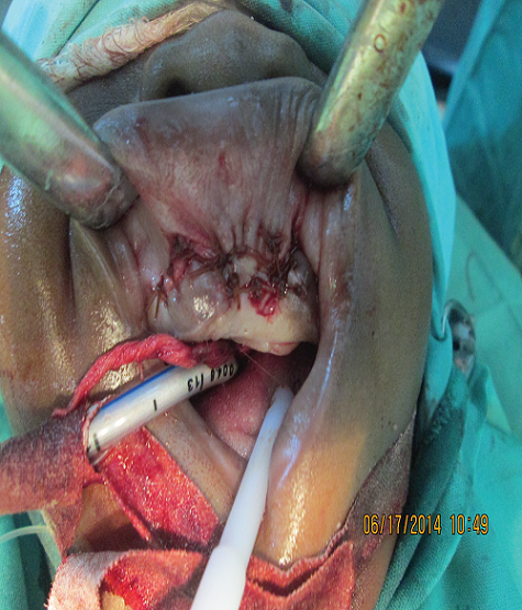 Figure 3: Melanotic neuroectodermal tumor of infancy: a rare presentation  of an extremely rare neoplasm and diagnostic implications in Gombe, Nigeria