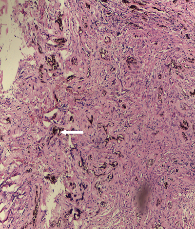 Figure 4: Melanotic neuroectodermal tumor of infancy: a rare presentation  of an extremely rare neoplasm and diagnostic implications in Gombe, Nigeria