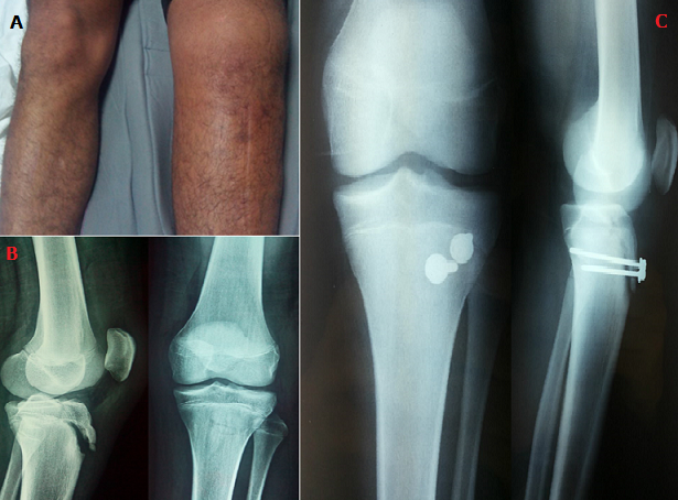 Figure Figure 1 Osgood schlatter Disease Risk Of A Disease Deemed Banal Figure Figure 1 Osgood schlatter Disease Risk Of A Disease Deemed Banal