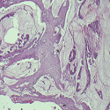Carcinoma of the colon in a 40 year old female: a case report