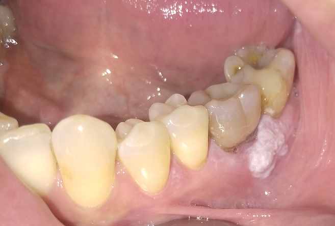 papilloma between teeth