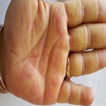 Concomitant Mediterranean spotted fever and systemic lupus ...