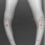 Not all the bowlegs are rickets! (a case report)