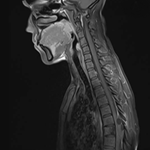 Primary costovertebral hydatidosis revealed by compressive myelitis: a ...