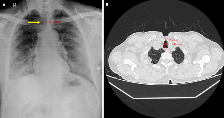 Incidental saber-sheath trachea in a non-chronic obstructive pulmonary disease patient: a radiologic curiosity