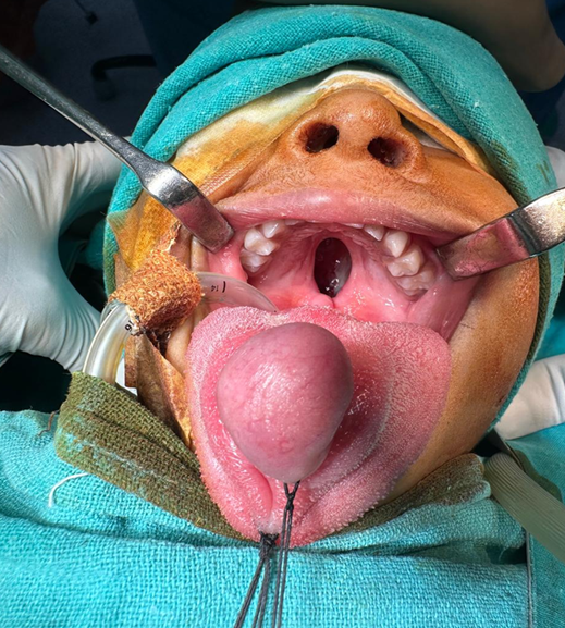 Congenital dermoid cyst of the tongue: a rare clinical image