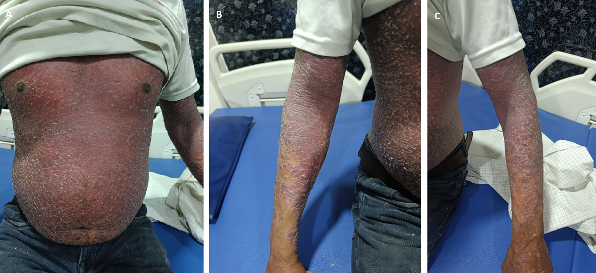 Erythrodermic psoriasis presenting with generalized scaling and erythema
