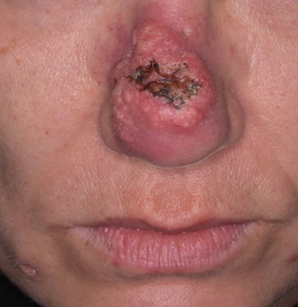 Ulcerated nodular lesion over the nasal tip suggestive of basal cell carcinoma