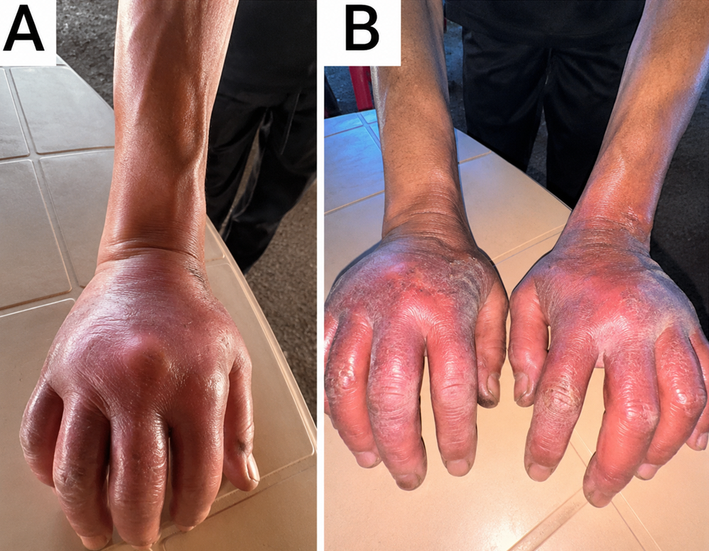 Severe bilateral irritant contact dermatitis following detergent exposure in an elderly male