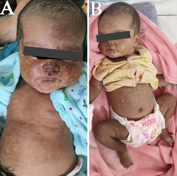 Chik sign in a neonate: a distinctive manifestation of vertically transmitted chikungunya