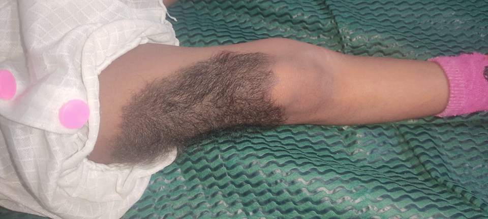 An atypical case of congenital melanocytic nevus on the thigh in a young child