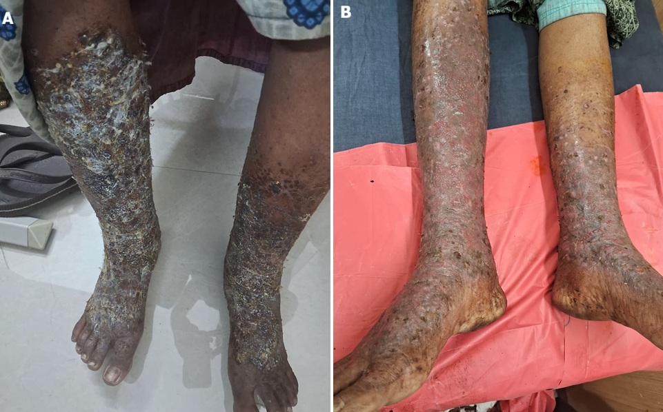 Steroid-modified eczema: clinical features and dermatological sequelae