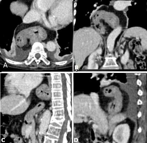A diagnostic twist: imaging of organoaxial gastric volvulus